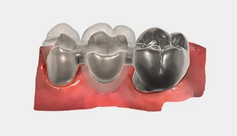 Carillas de porcelana