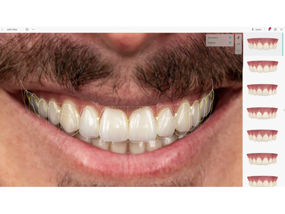 Simulación clínica de alineación y diseño digital de una sonrisa.