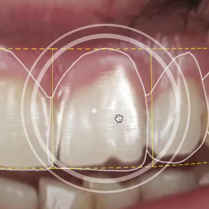 Vista clínica de dientes anteriores con medición visual de alineación dental.