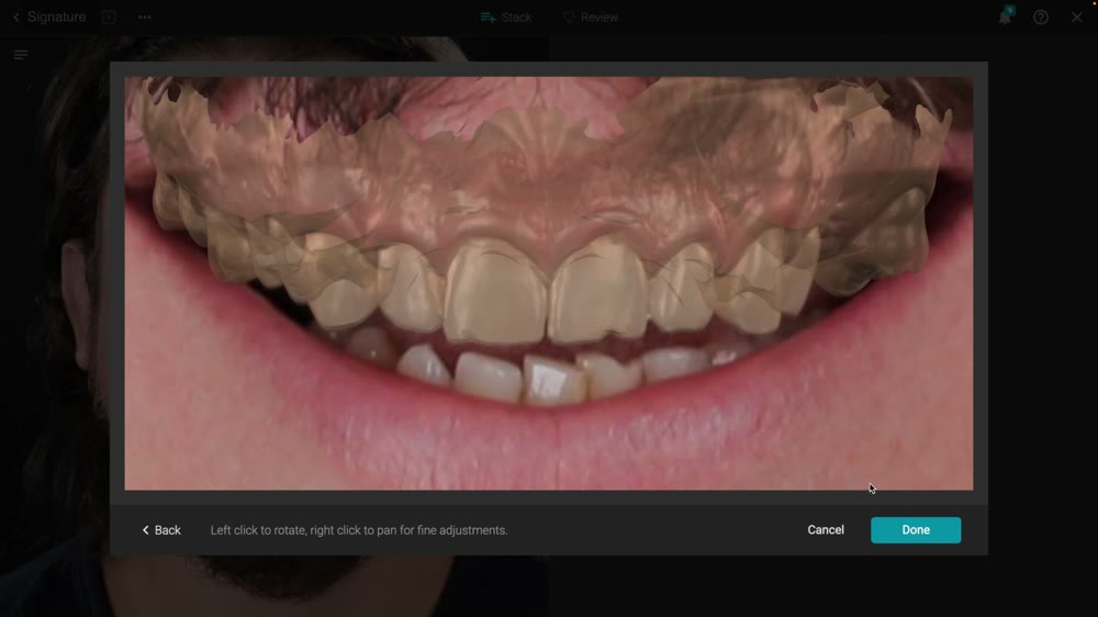 Simulación digital de diseño de sonrisa sobre la dentición.